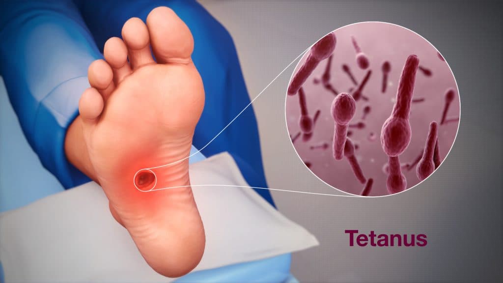 Kejang atau kaku otot yang disebabkan oleh infeksi bakteri clostridium tetani disebut