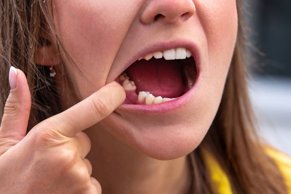 Cara mengatasi gigi goyang agar cepat copot pada orang dewasa