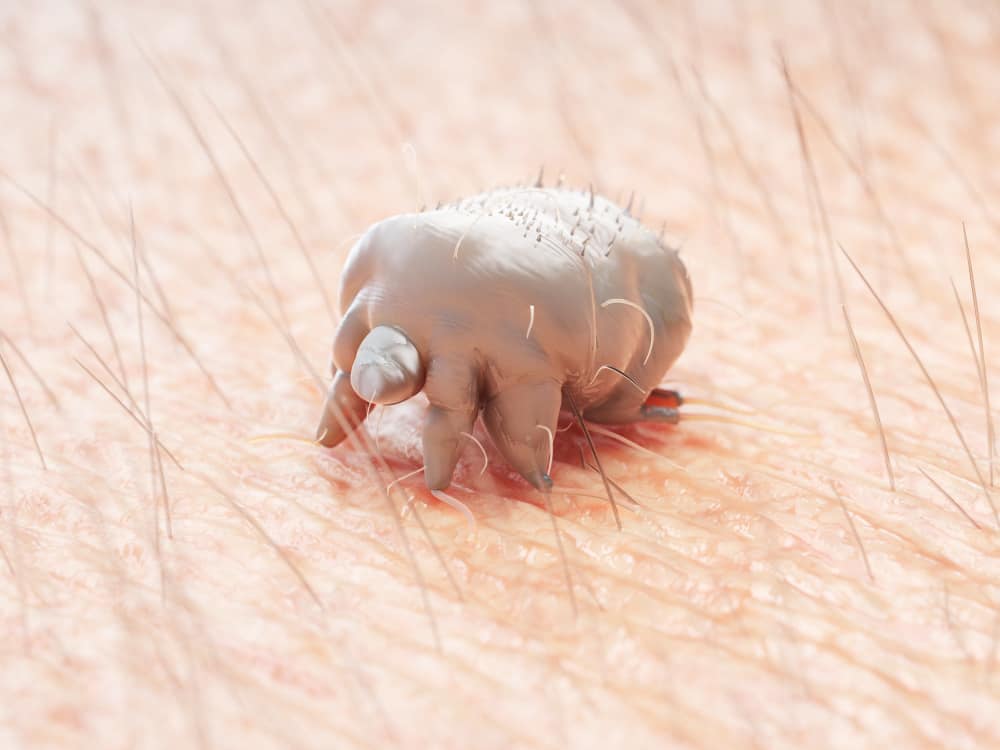 kulit gatal karena scabies
