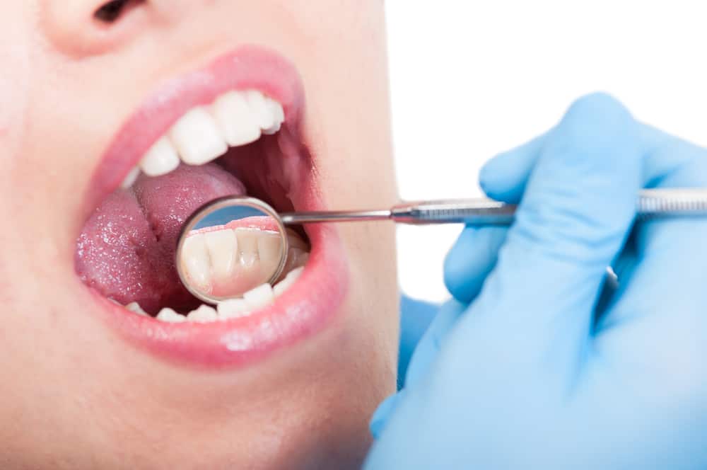 Jangan Anggap Sepele Ini 5 Penyebab Karang Gigi yang 