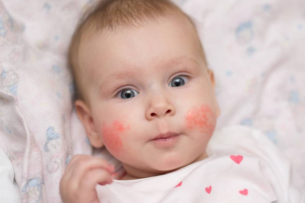 alergi detergen pada bayi